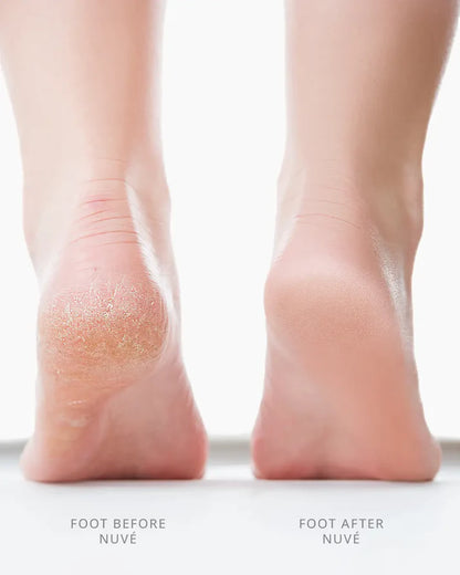 DermaSole™ Electric Foot Callus Remover